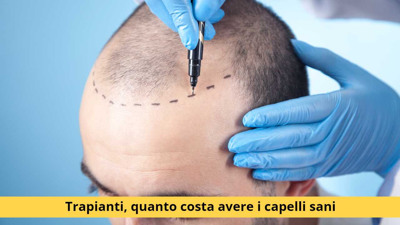 trapianto costi